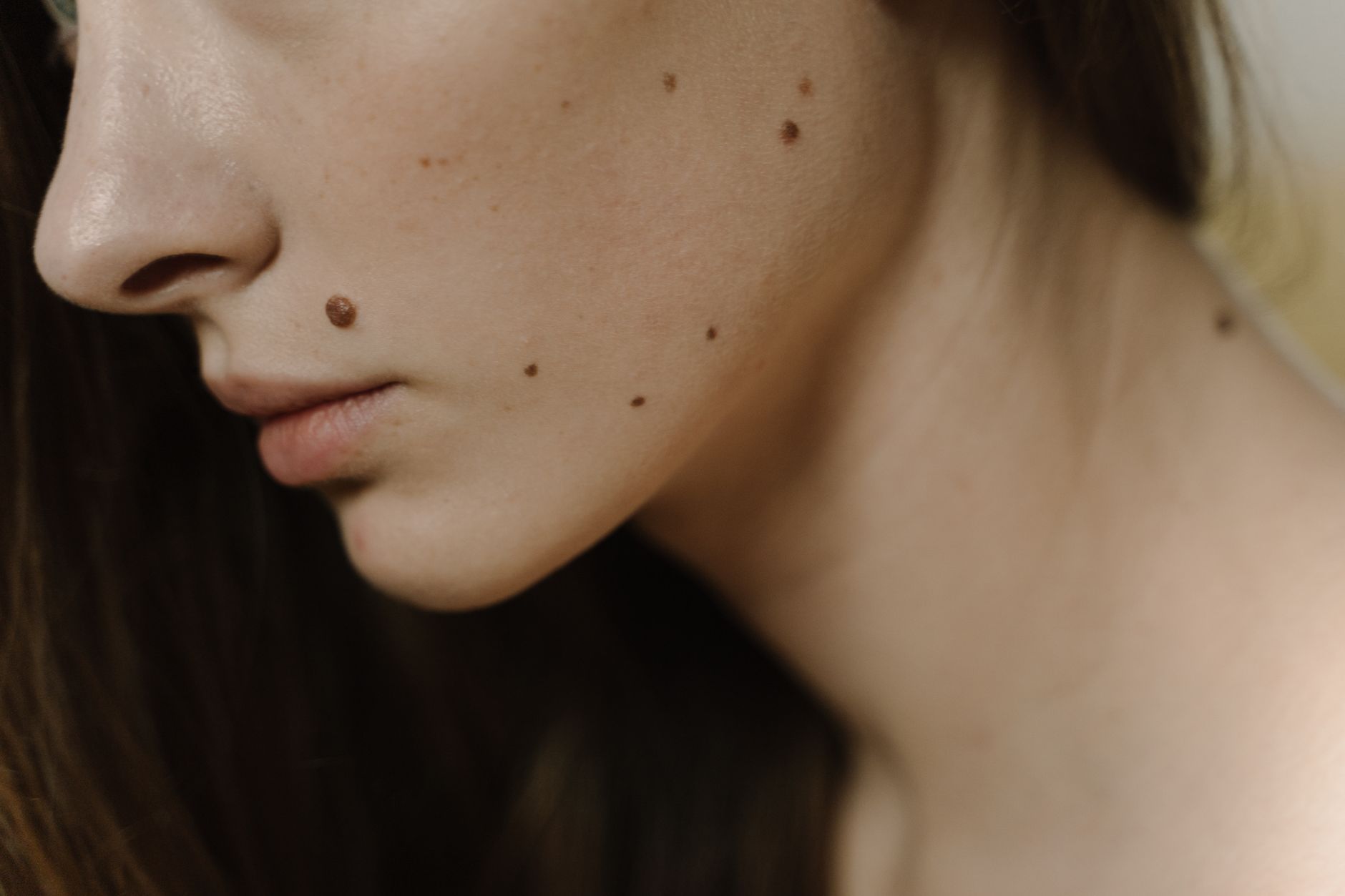 Skin Tag: Punca, Tanda dan Pilihan Rawatan Yang Anda Perlu Tahu